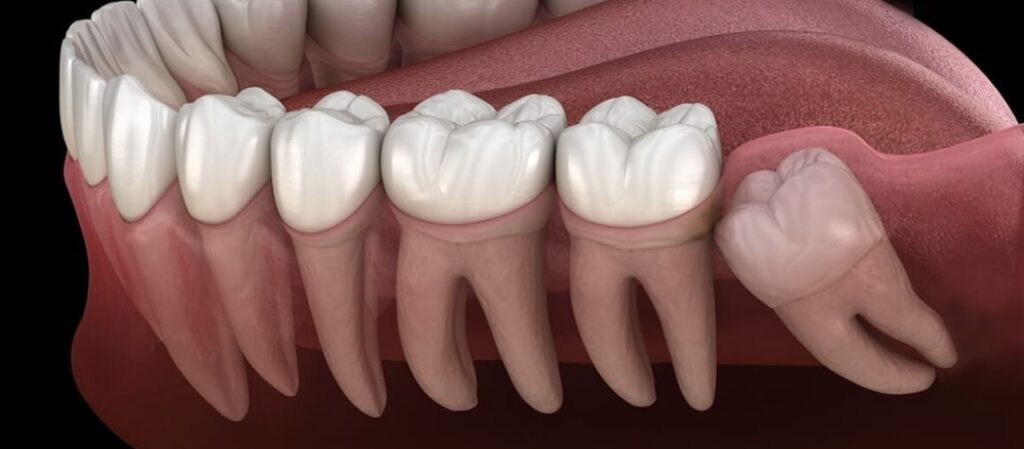 رسم ثلاثي الأبعاد يوضح المشاكل الشائعة لضروس العقل، بما في ذلك الانطمار والتسوس والضغط على الأسنان المجاورة.