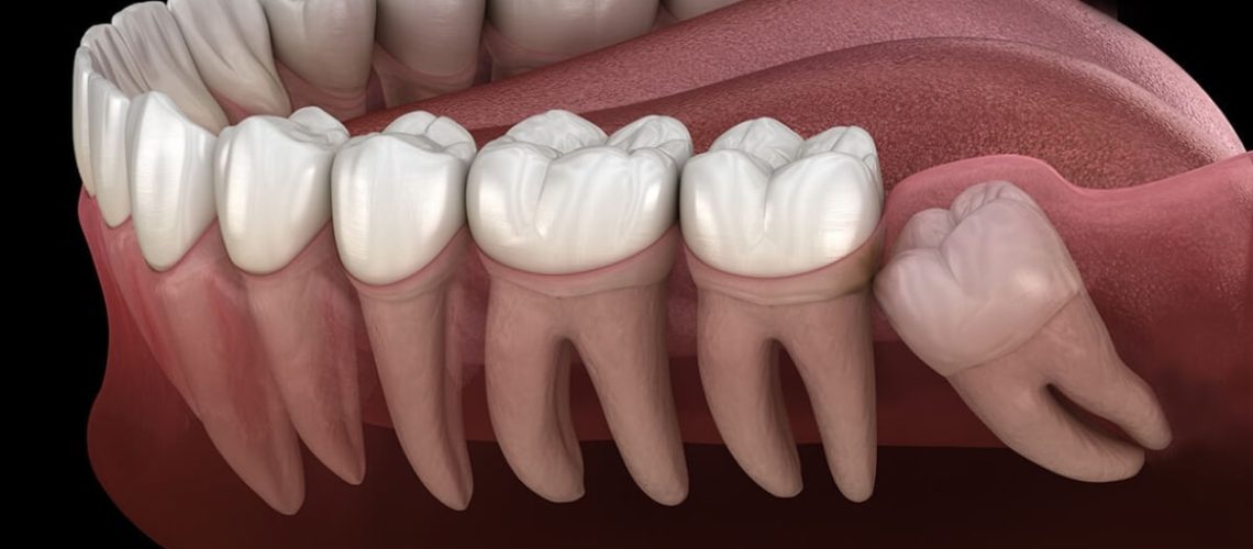 رسم ثلاثي الأبعاد يوضح المشاكل الشائعة لضروس العقل، بما في ذلك الانطمار والتسوس والضغط على الأسنان المجاورة.