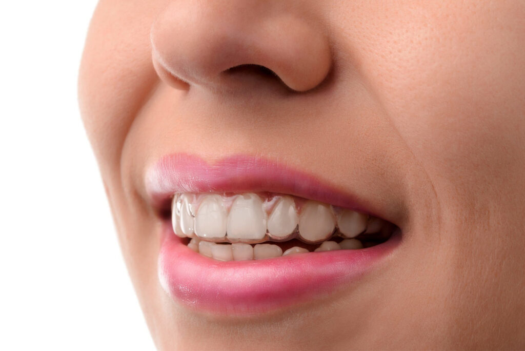 المثبّت الشفاف (Essix Retainer)