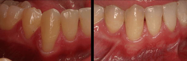 تغطية جذور الاسنان المكشوفة - دكتور محمد عبدالوهاب السعدني