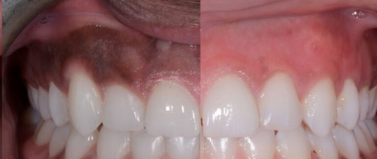 توريد اللثة | أفضل دكتور اسنان في المنصورة