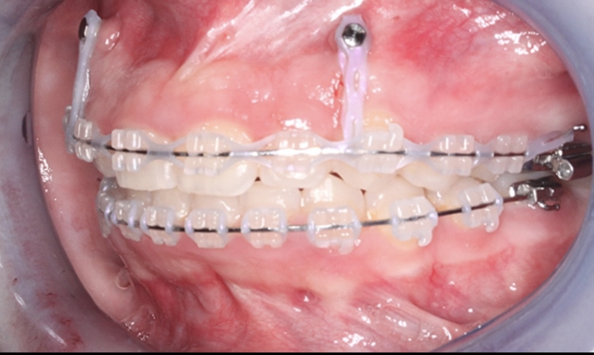 تقويم الاسنان لعلاج الابتسامة اللثوية - دكتور محمد عبدالوهاب السعدني - احسن دكتور اسنان في المنصورة
